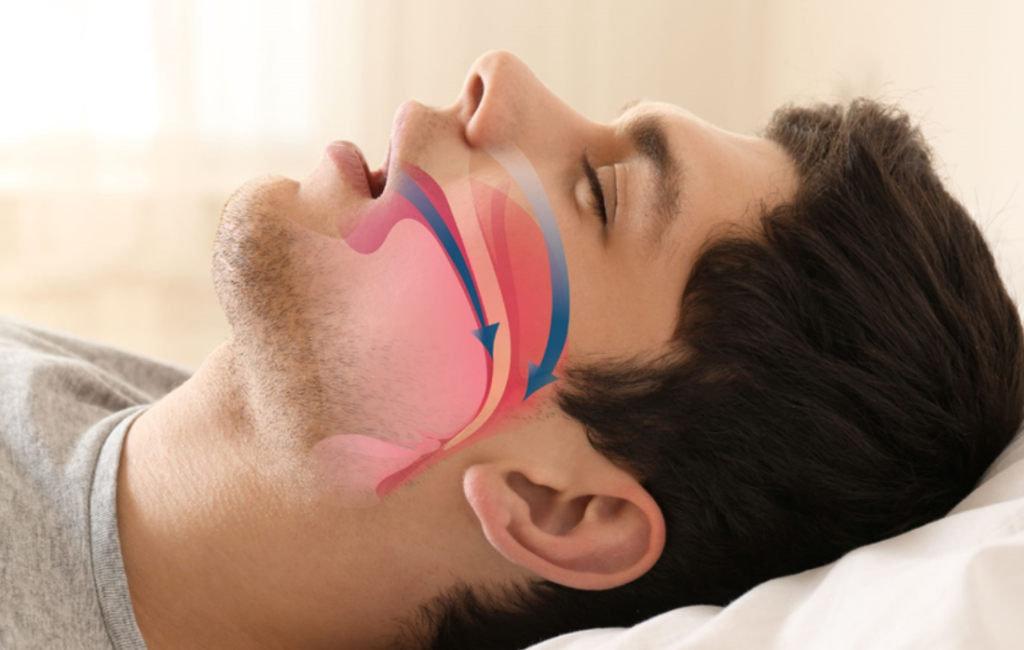 Lifestyle Changes for Managing Sleep Apnea