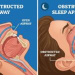 Person experiencing obstructive sleep apnea with airway blockage during sleep