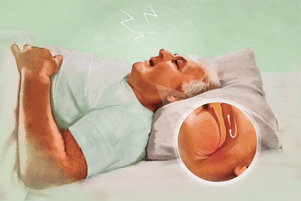 Person struggling to sleep due to summer heat and sleep apnea breathing issues