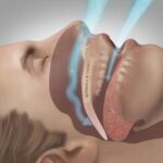 Person experiencing sleep apnea during sleep with airway obstruction illustration