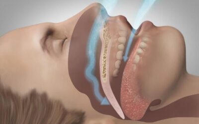 Person experiencing sleep apnea during sleep with airway obstruction illustration