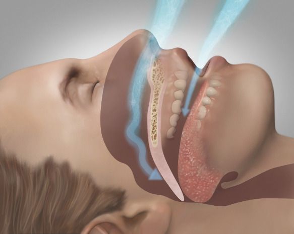 Person experiencing sleep apnea during sleep with airway obstruction illustration